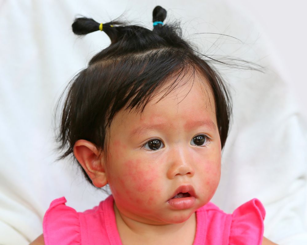 Baby girl with red eyebrows due to skin condition